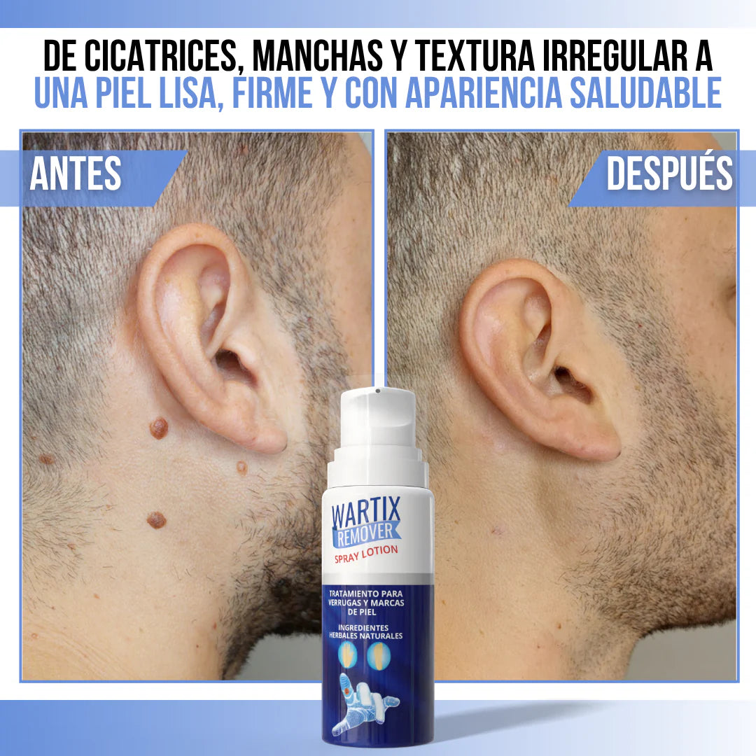 WARTIX REMOVER™ - Elimina verrugas y lunares con suavidad y rapidez
